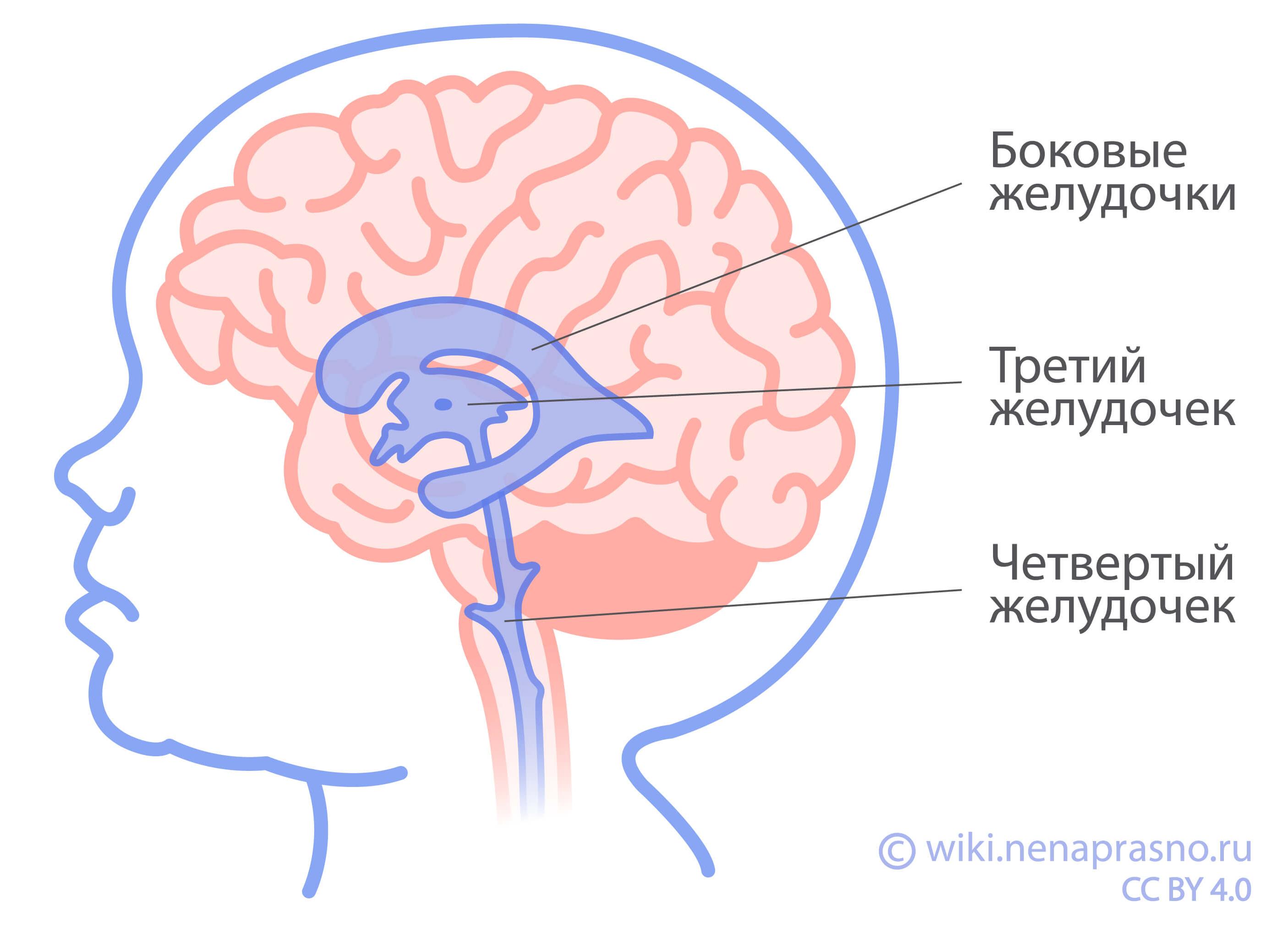 Киста сосудистого сплетения головного мозга у плода и новорожденного