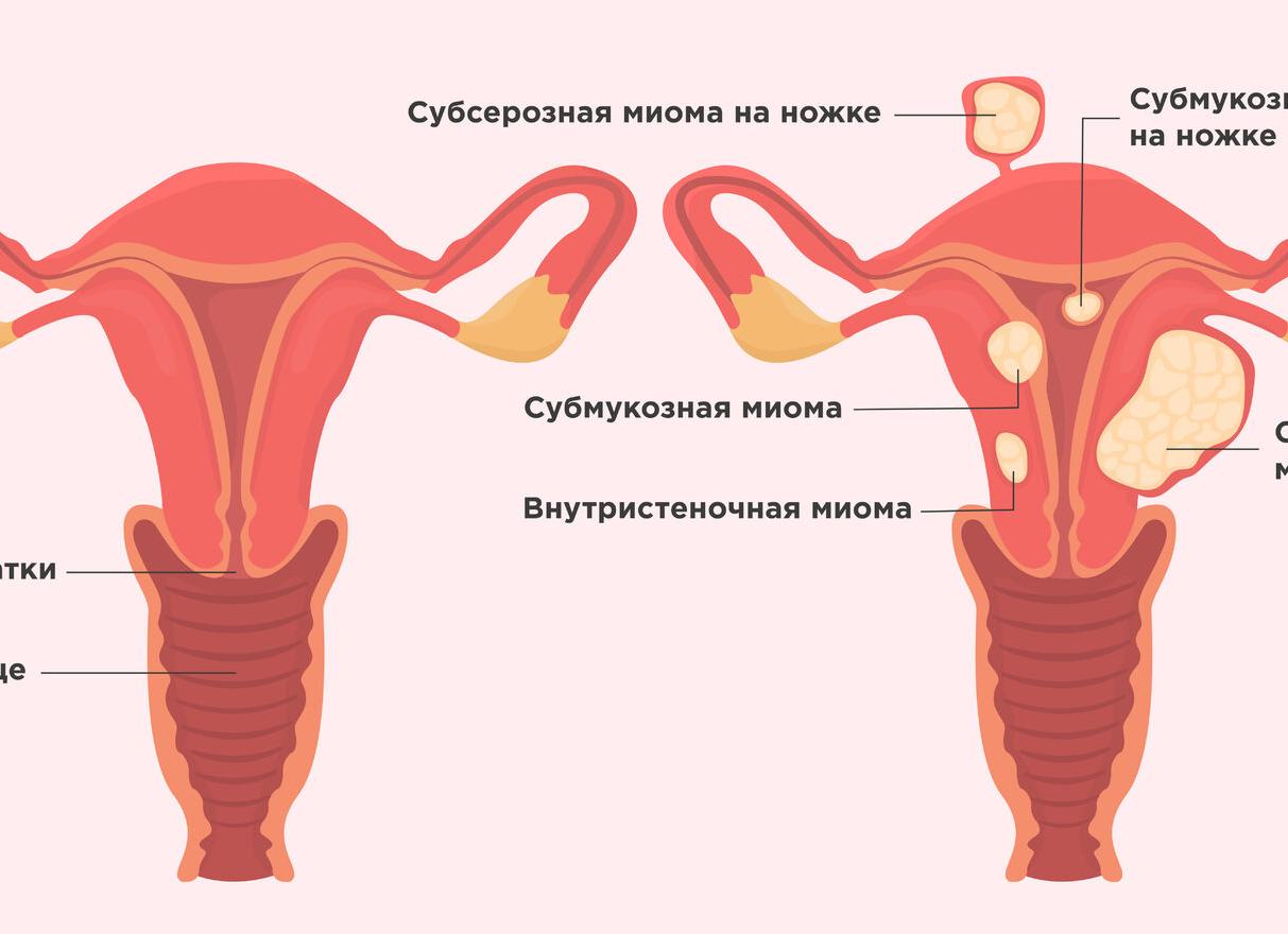 Миома после родов