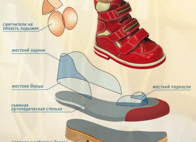 Обувь при плосковальгусной стопе у детей — как выбрать правильную