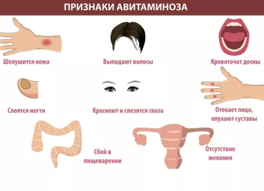 Признаки авитаминоза у женщин — первые симптомы и проявления