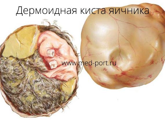 Симптомы и лечение дермоидной кисты левого и правого яичника