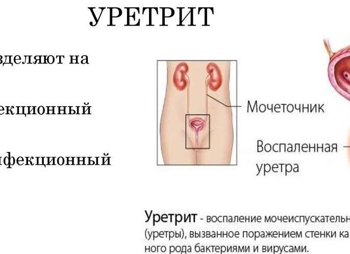 Уретрит у мужчин — причины возникновения, симптомы, диагностика, методы лечения и профилактики