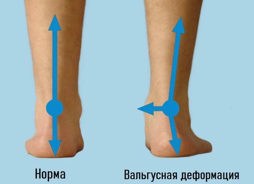 Вальгусная деформация стоп