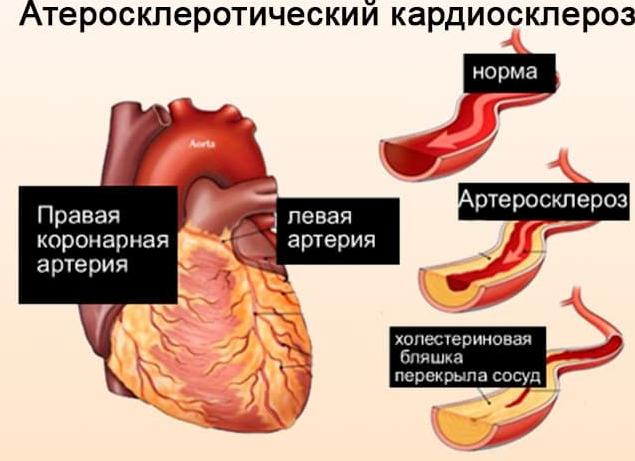 Атеросклеротический кардиосклероз — причины и лечение заболевания