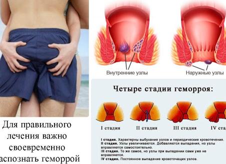 Эффективные способы лечения наружного геморроя
