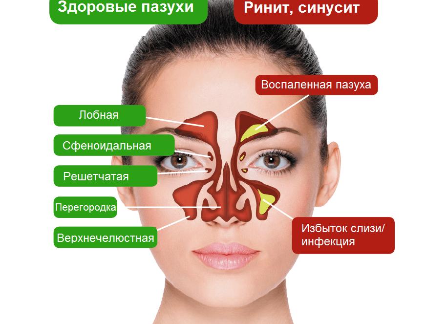 Гайморит у взрослых: симптомы и лечение