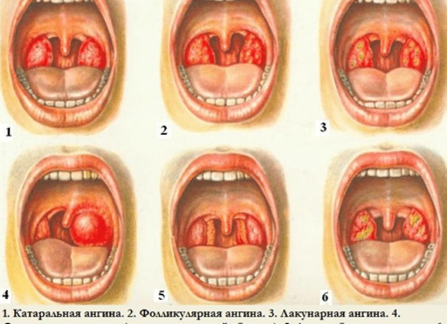 Гнойная ангина — причины и симптомы, диагностика и способы лечения