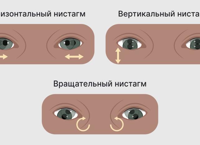 Что такое окулогирный криз и что вызывает судорогу взора?