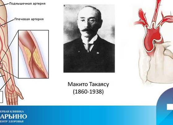 Болезнь Такаясу: диагностика и лечение