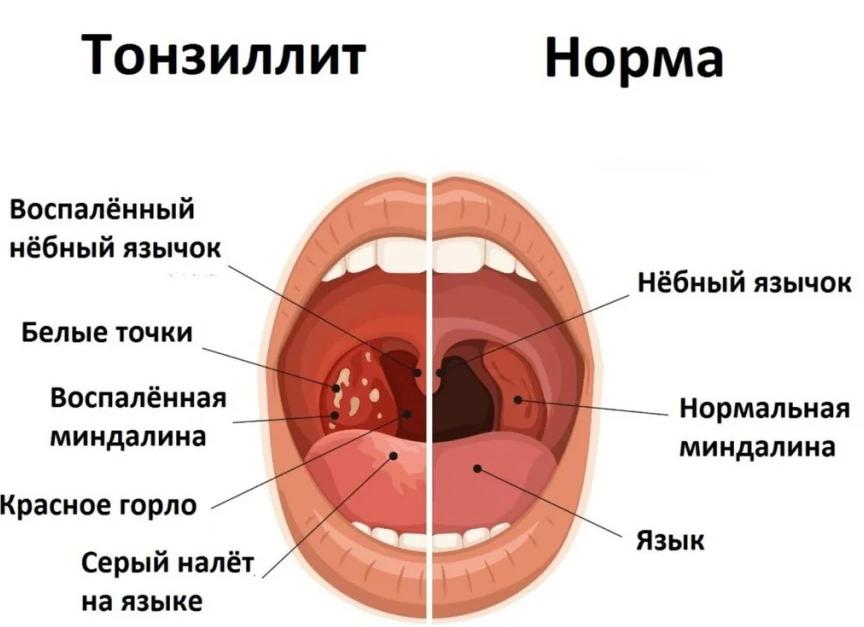 Лечение ларингита у медикаментозными и народными средствами у ребенка или взрослого