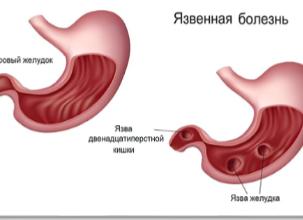 Профилактика язвенной болезни желудка — правила первичной и вторичной