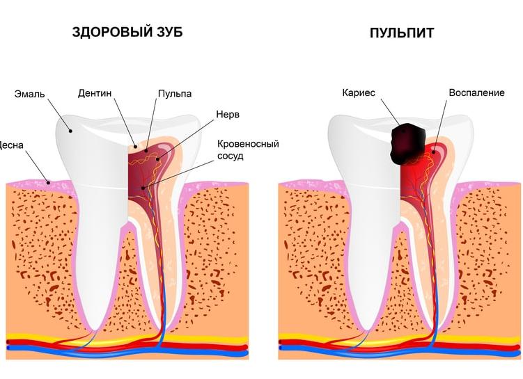 Что такое пульпит зуба и как происходит лечение?