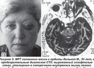Многоликий синдром Толосы-Ханта: симптомы и лечение