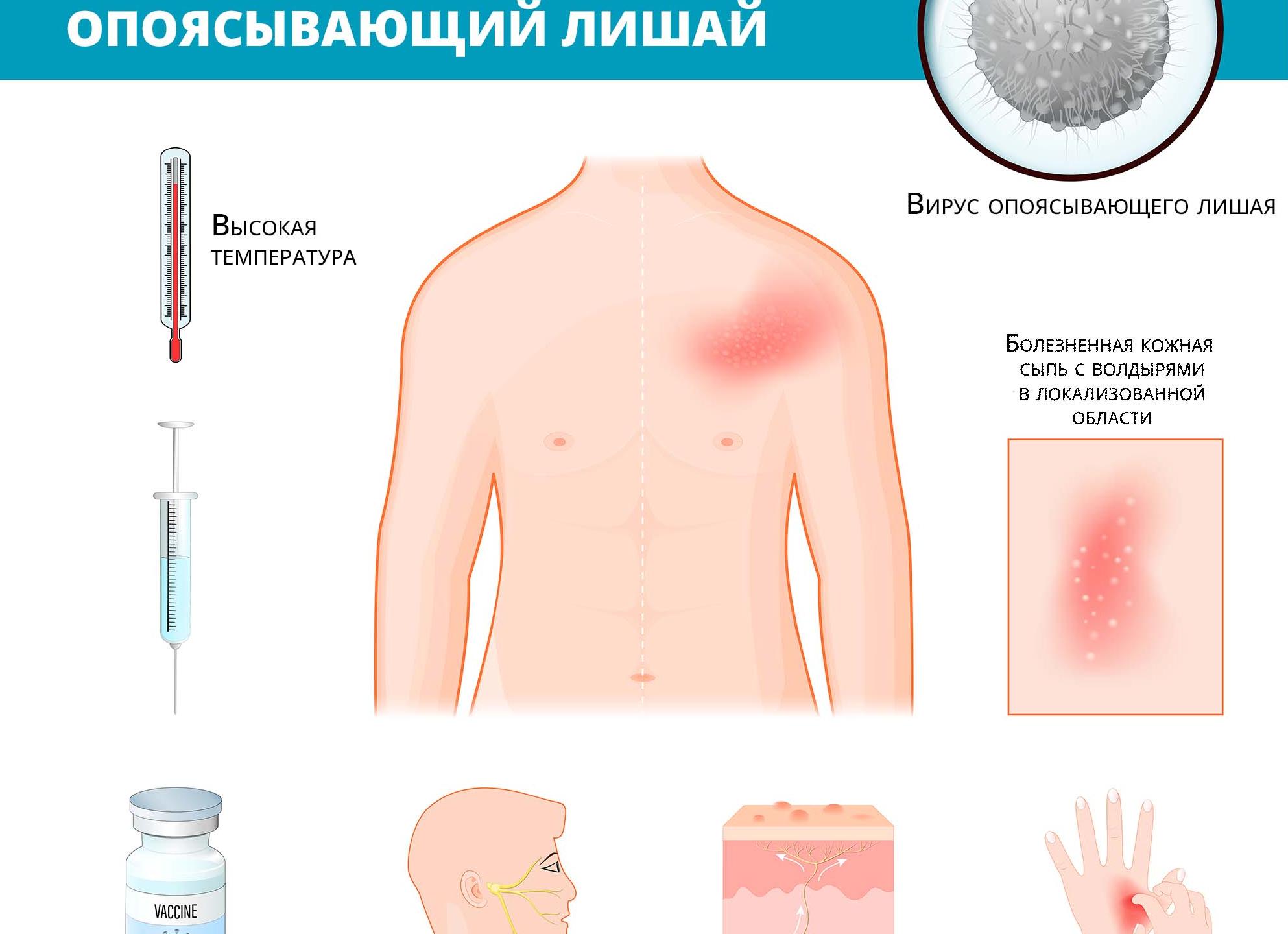 Опоясывающий герпес