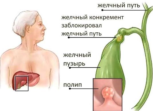 Полипы в желчном пузыре — виды, симптомы, диагностика и лечение
