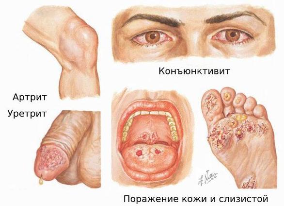 Цирцинарный баланопостит — причины возникновения и методы лечения