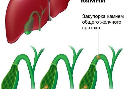 Диета при болезни желчного пузыря: тактика составления лечебного питания при различных заболеваниях