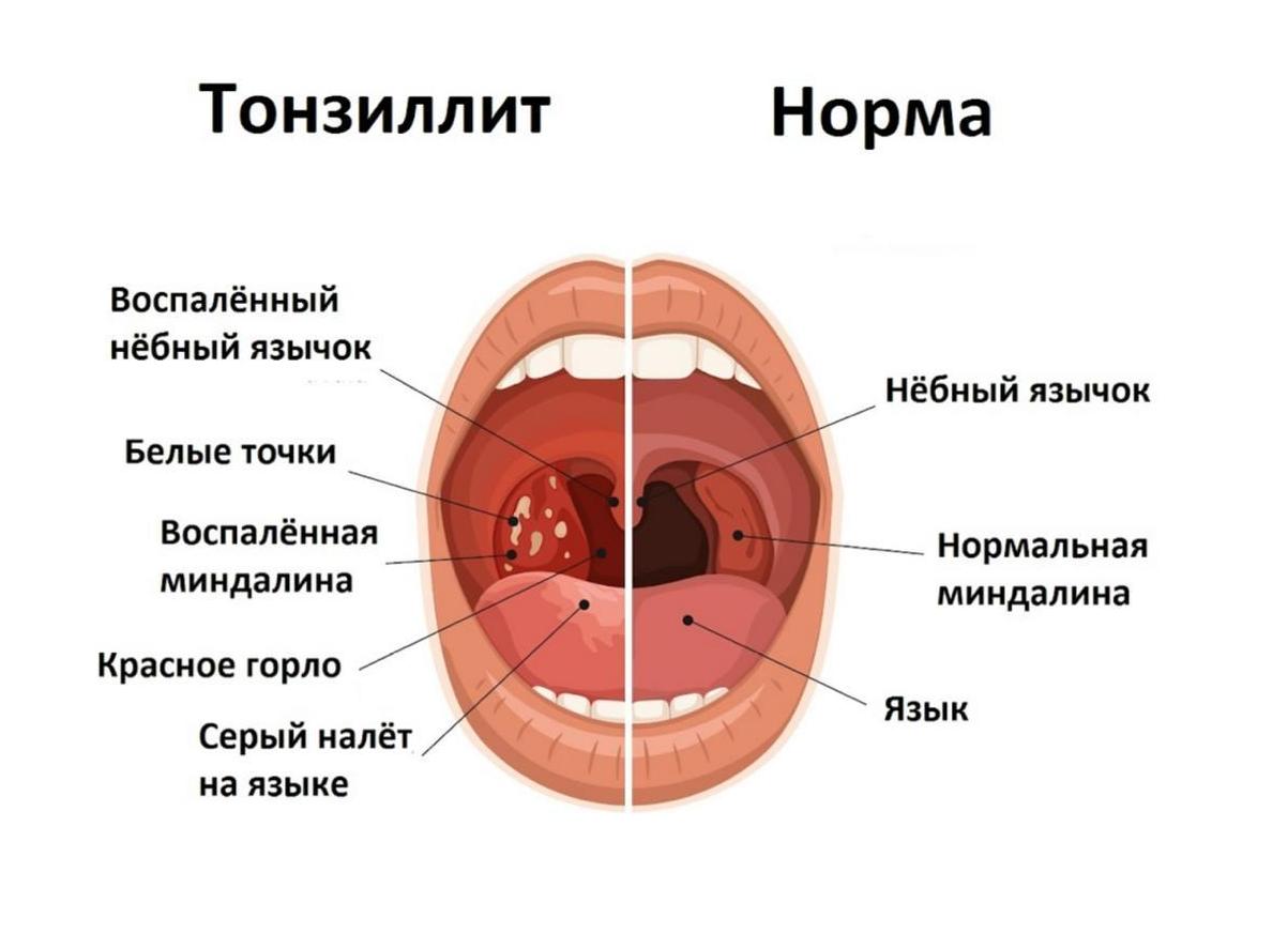 Как лечить хронический тонзиллит и его обострение у ребенка?