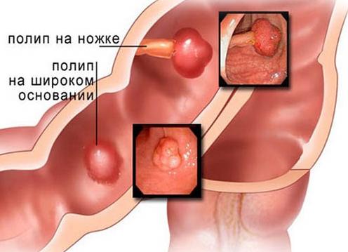Полипы в кишечнике — причины возникновения, симптомы и удаление