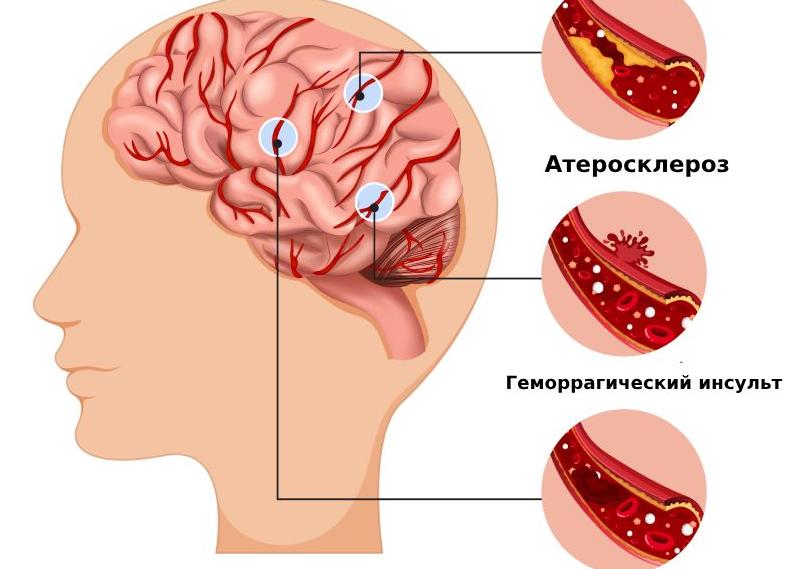 Виды инсульта — причины и симптомы заболевания, диагностика, способы лечения и профилактические меры