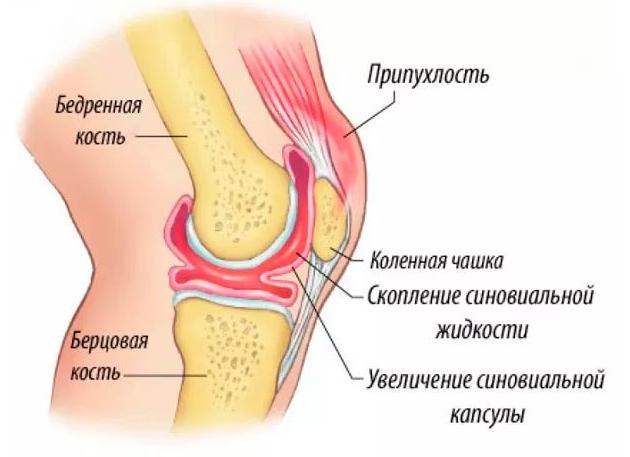 Жидкость в коленном суставе — причины скопления, диагностика, лечение медикаментами и хирургическим путем
