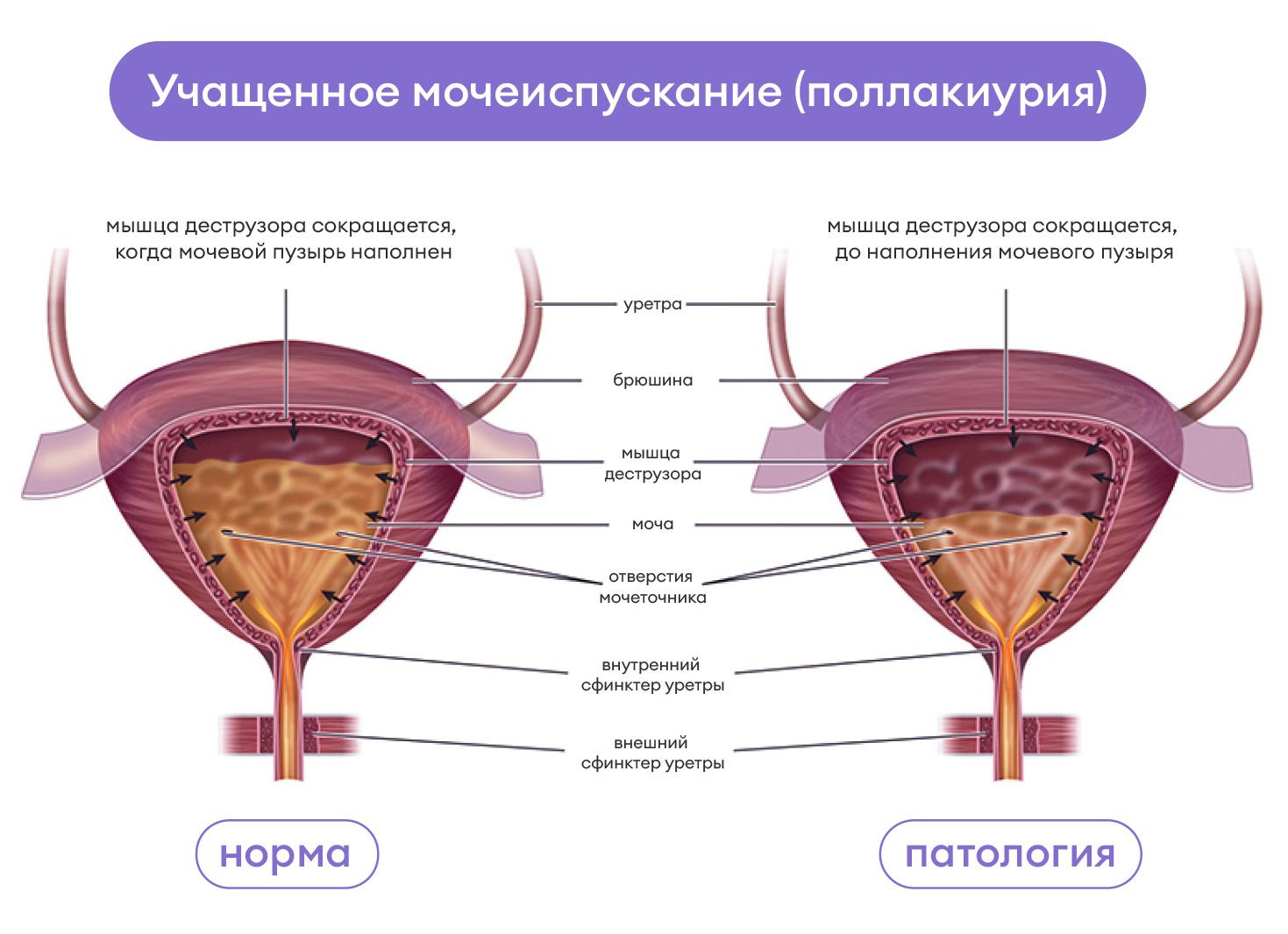 Частое мочеиспускание у мужчин