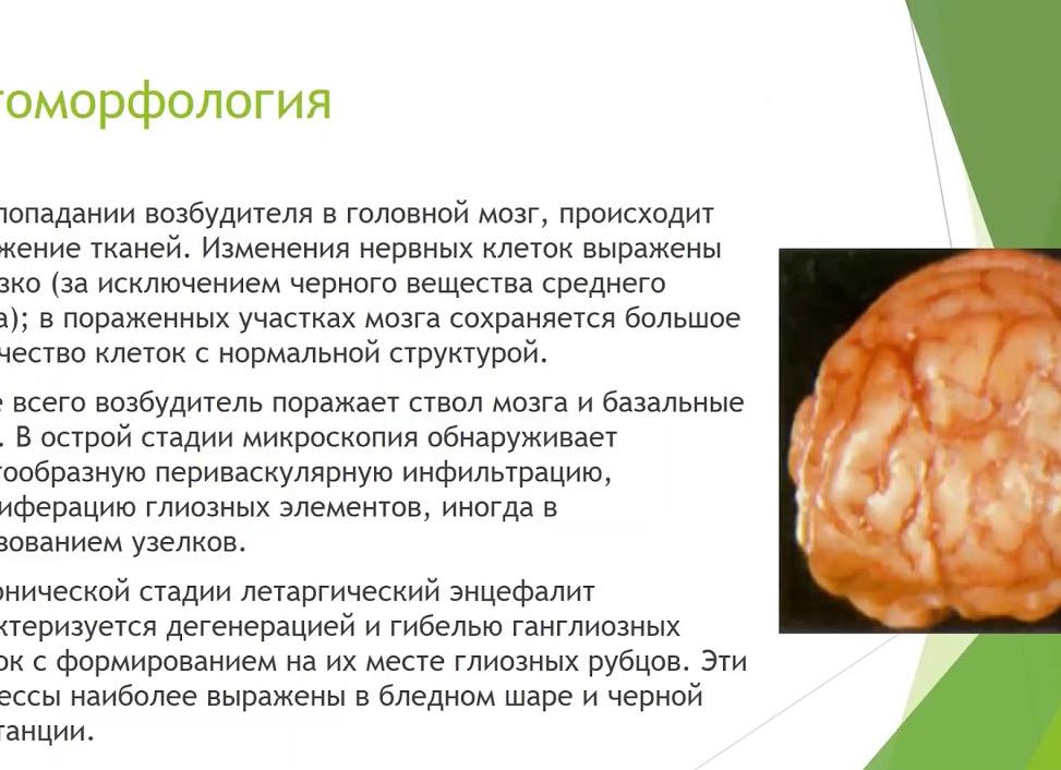 Летаргический энцефалит Экономо в острой и хронической формах течения