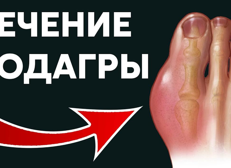 Как лечить подагру в домашних условиях