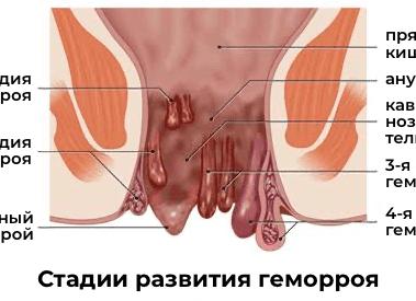 Как вылечить геморрой в период лактации с помощью мазей и свечей?