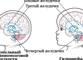 Особенности развития и лечения гидроцефалии головного мозга у взрослого — симптомы, признаки и фото патологии