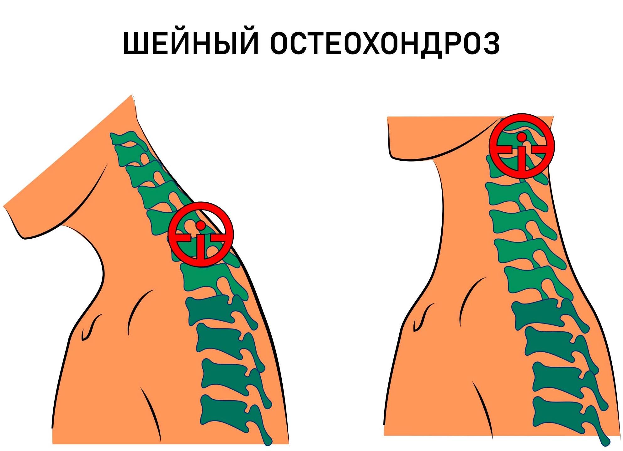Узнаем все симптомы шейного хондроза