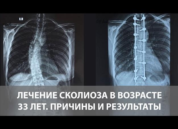 Как лечить сколиоз грудного отдела позвоночника?