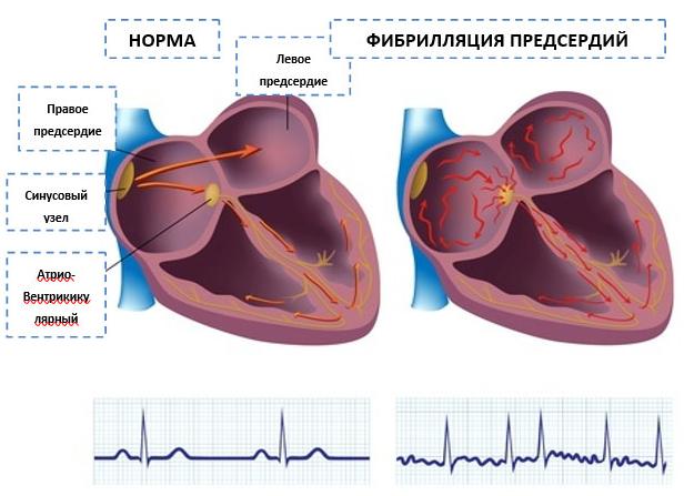 Пароксизмальная форма фибрилляции предсердий — причины и симптомы, диагностика, методы лечения и осложнения