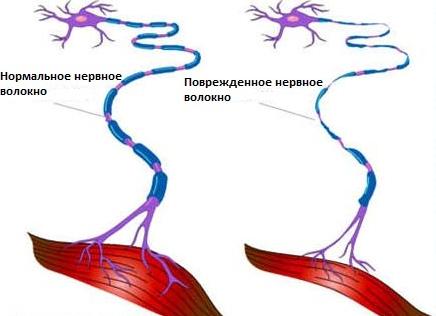 Причины бокового амиотрофического склероза — симптомы и проявления