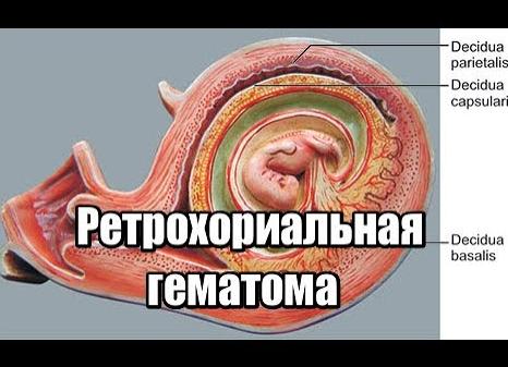 Ретрохориальная гематома — причины и симптомы заболевания, диагностика и проявления, методы лечения