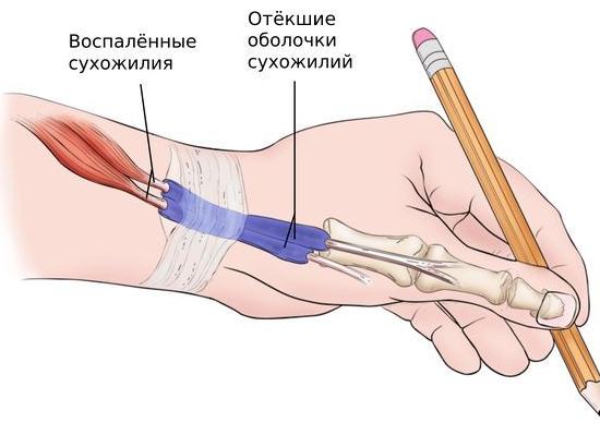 Болезнь де Кервена — причины, симптомы, оперативное и консервативное лечение