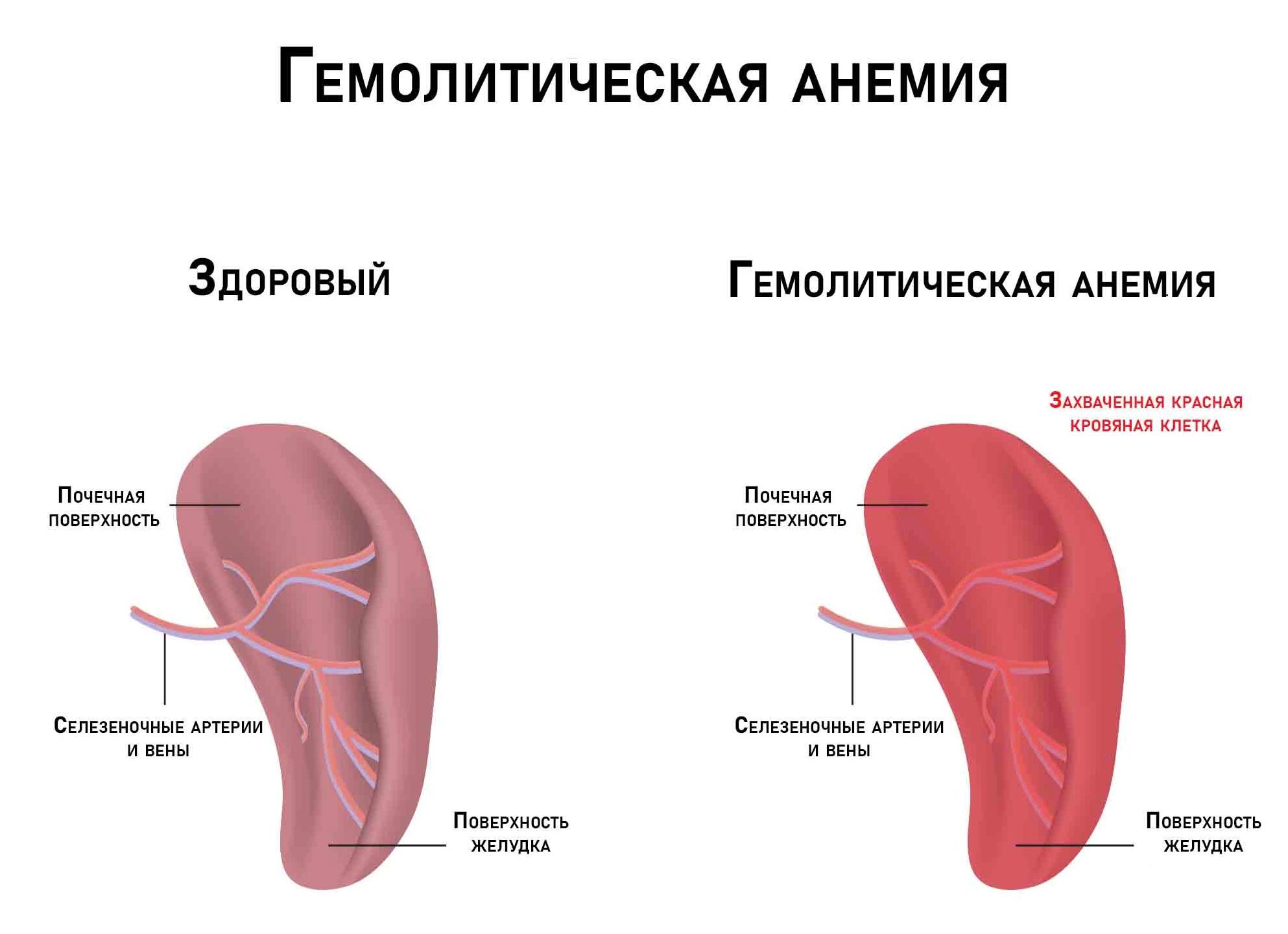Гемолитическая анемия — причины возникновения, симптомы и диагностика