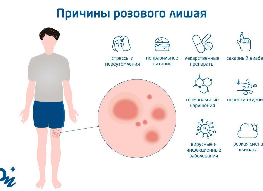 Розовый лишай у человека — причины возникновения, симптомы и лечение