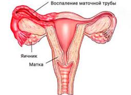 Сальпингоофорит в острой и хронической форме — причины, симптомы, диагностика и методы лечения
