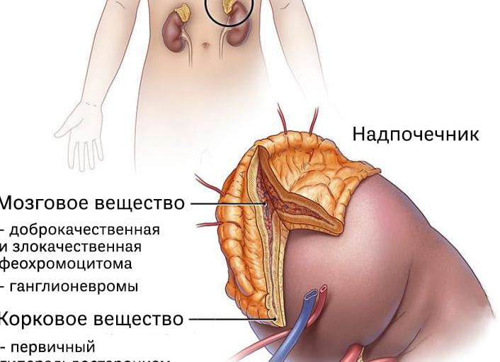 Аденома надпочечника у женщин — причины возникновения и лечение