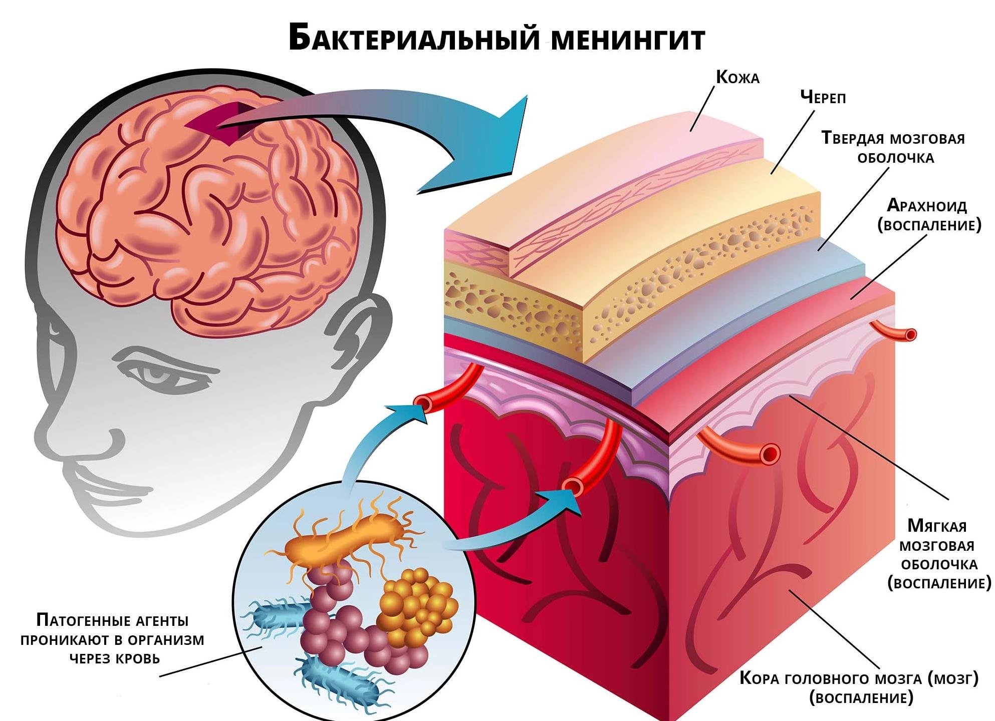 Бактериальный менингит — есть ли шансы у пациента?