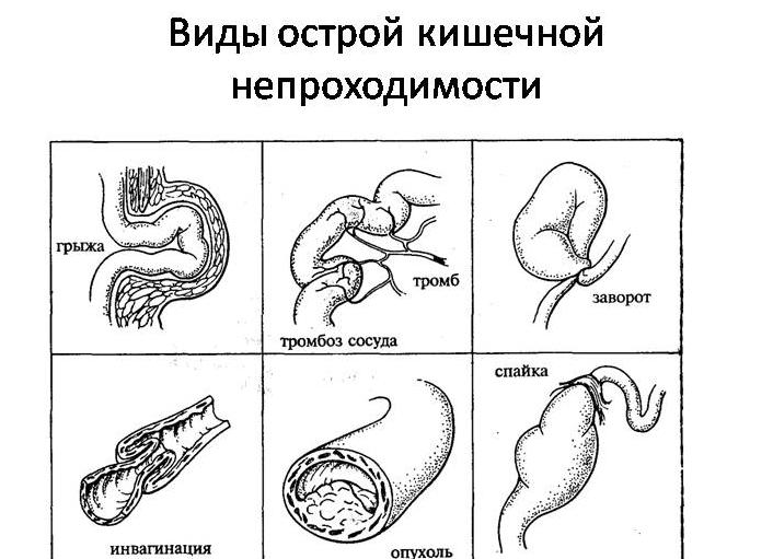 Кишечная непроходимость