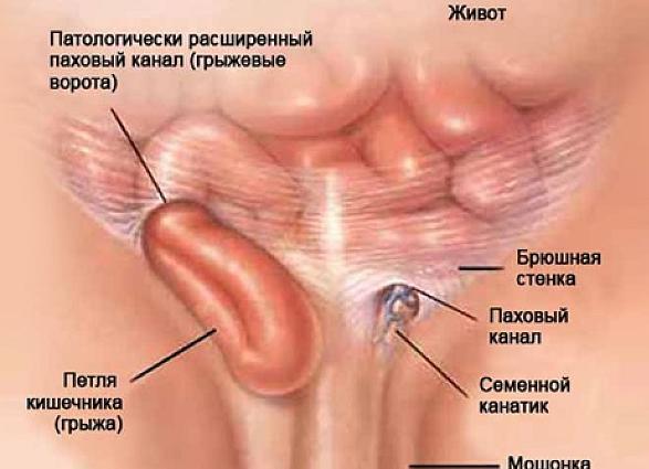 Паховая грыжа у мужчин