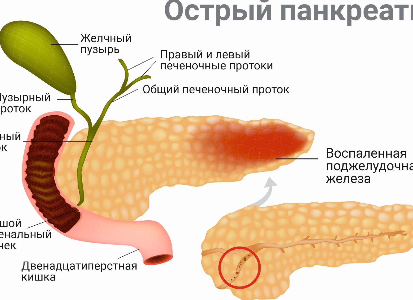 Приступ панкреатита: симптомы и лечение