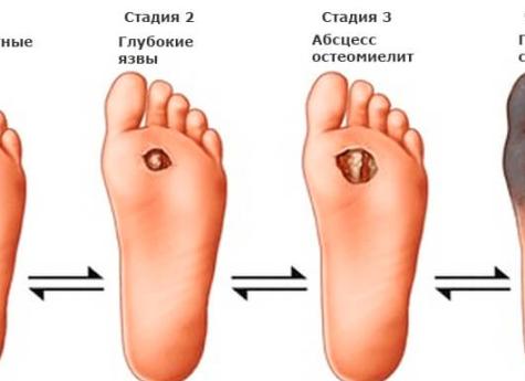 Что такое диабетическая стопа: стадии и лечение