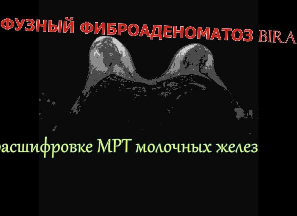 Диффузный фиброаденоматоз молочных желез