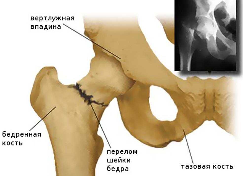 Перелом шейки бедра