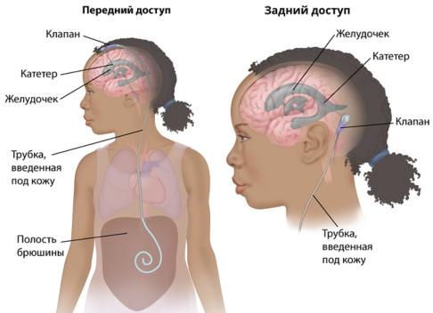 Что такое астроцитома головного мозга —  симптомы, лечение и прогноз жизни