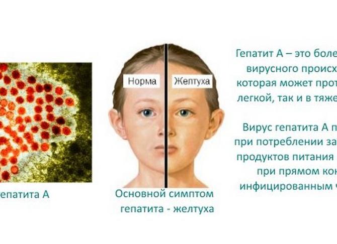Симптомы вирусного гепатита А у детей — признаки тяжелых форм болезни