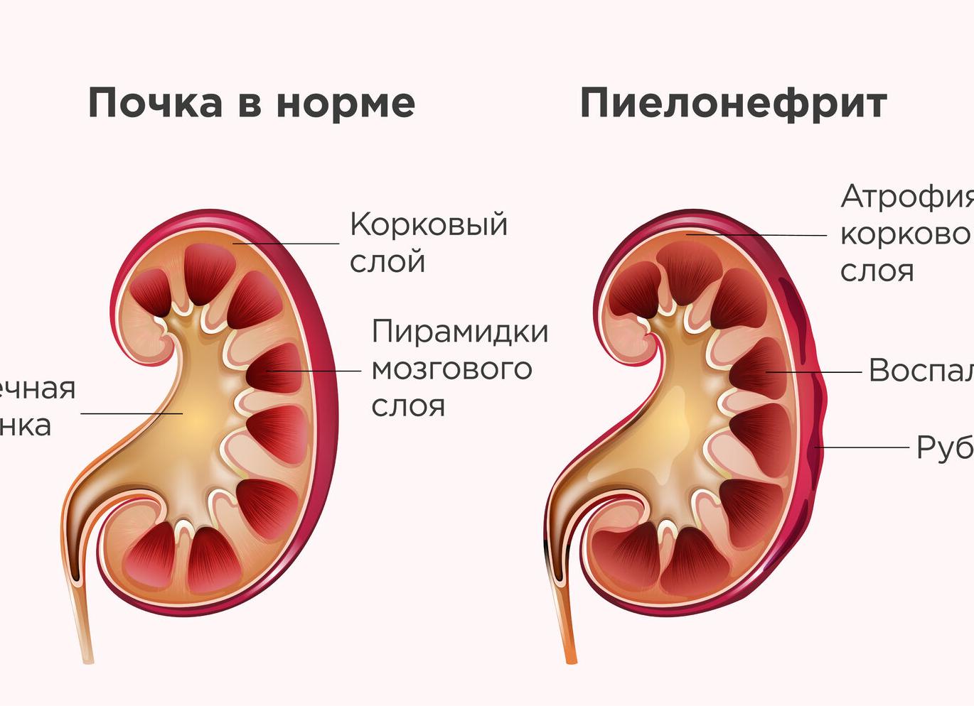 Почему могут болеть почки при беременности?